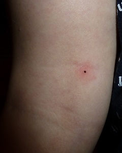 Eickemeyer - Edelstahl Zeckenpinzette nach Fark, 12cm