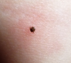 Eickemeyer - Edelstahl Zeckenpinzette nach Fark, 12cm