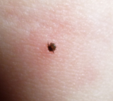 Eickemeyer - Edelstahl Zeckenpinzette nach Fark, 12cm